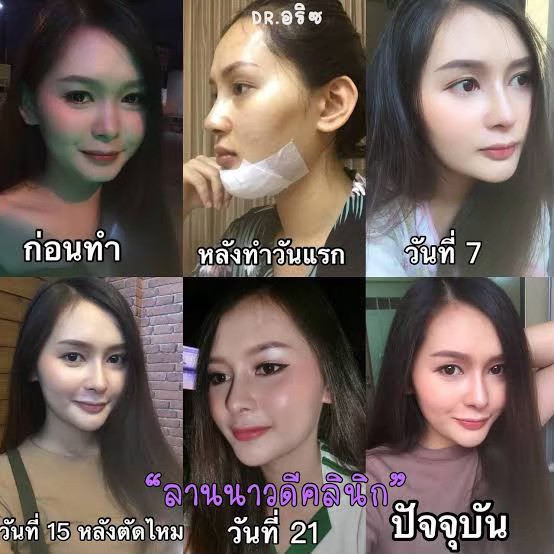 รีวิวเสริมคาง