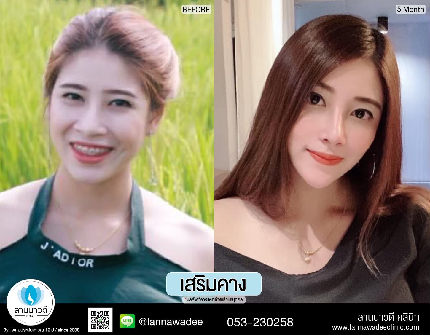 รีวิวเสริมคาง