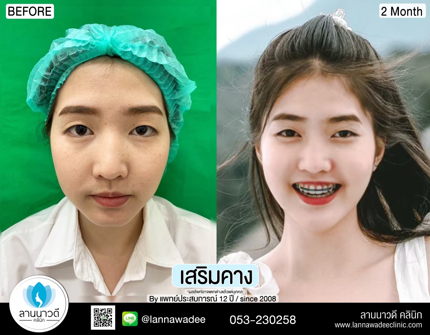 รีวิวเสริมคาง