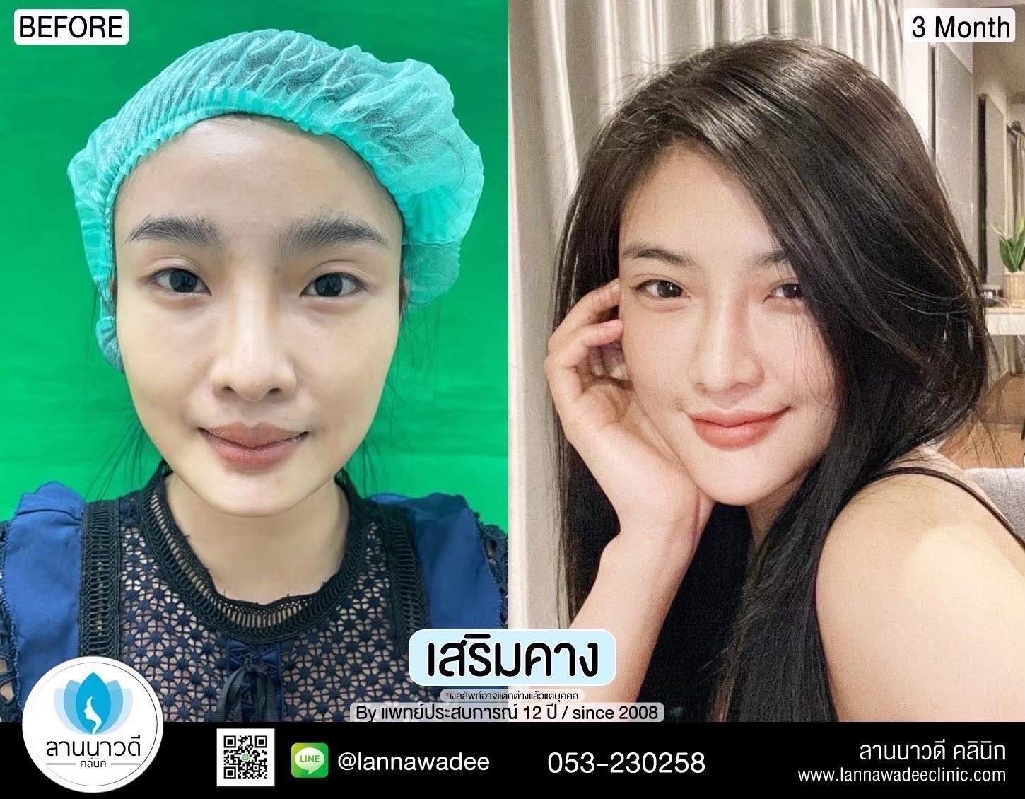 รีวิวเสริมคาง