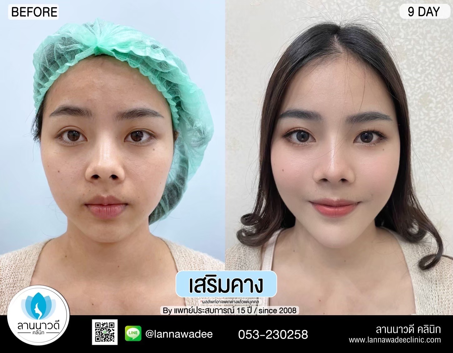 รีวิวเสริมคาง