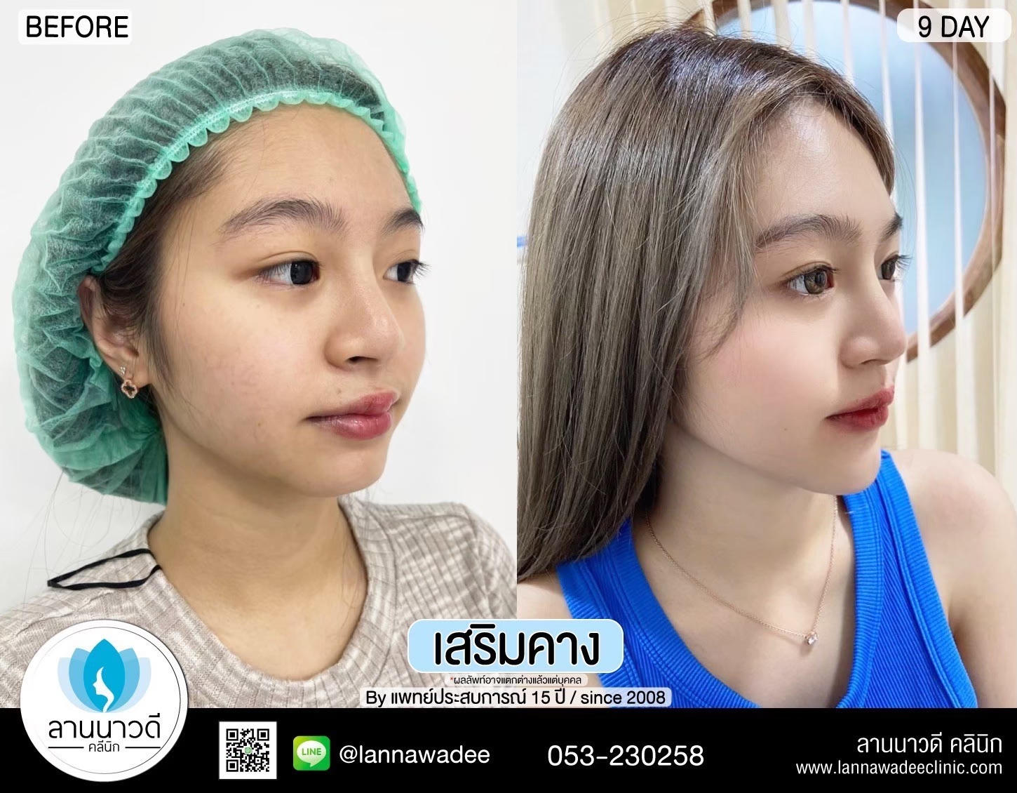 รีวิวเสริมคาง