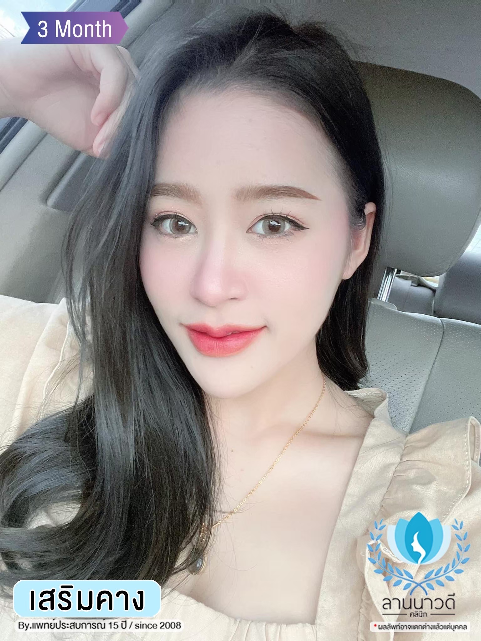 รีวิวเสริมคาง