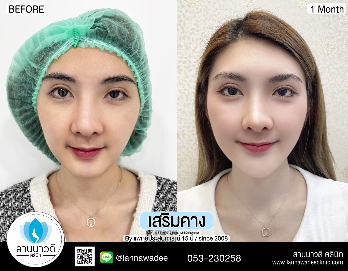 รีวิวเสริมคาง
