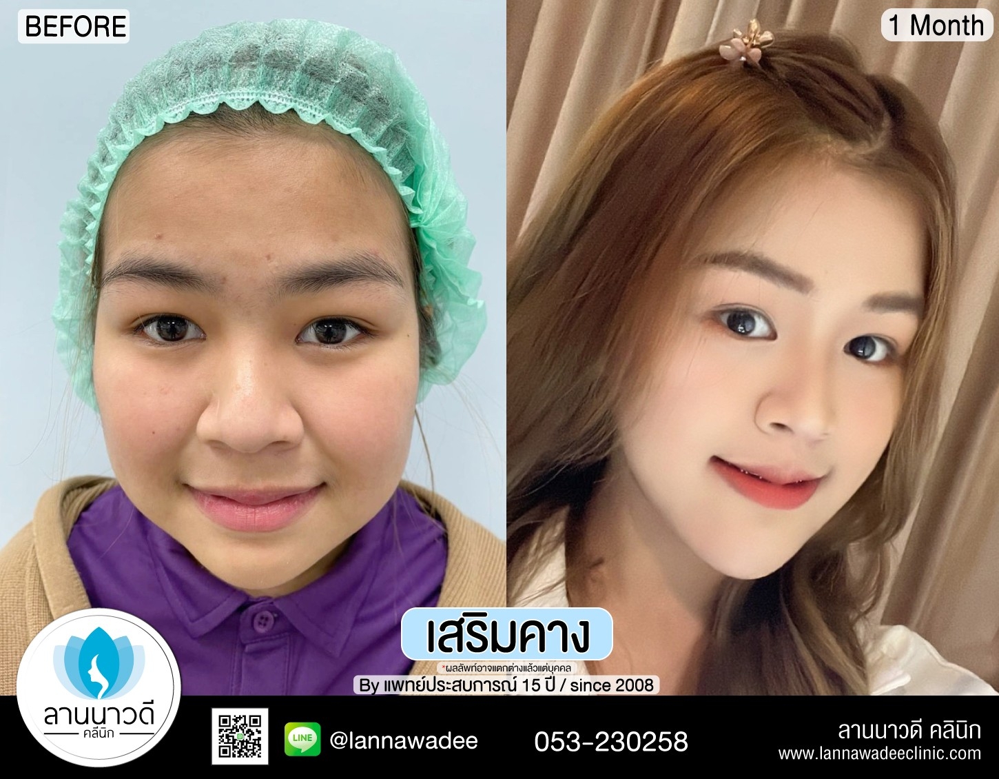 รีวิวเสริมคาง
