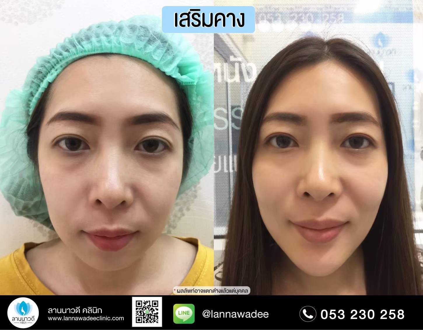 รีวิวเสริมคาง