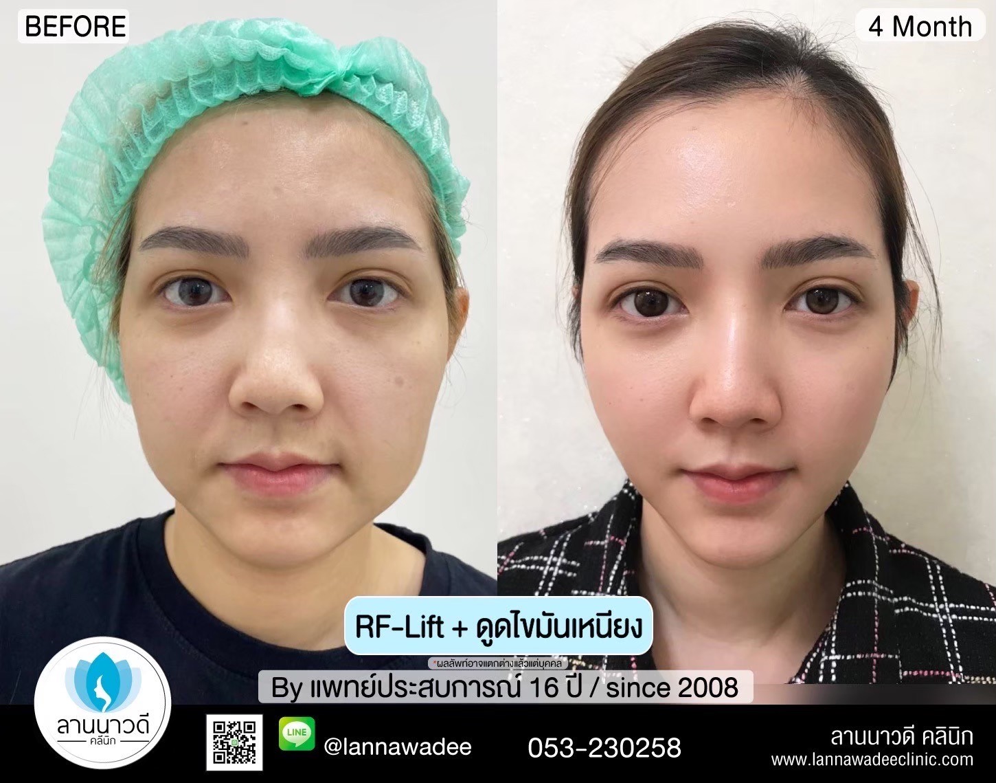 นวด RF