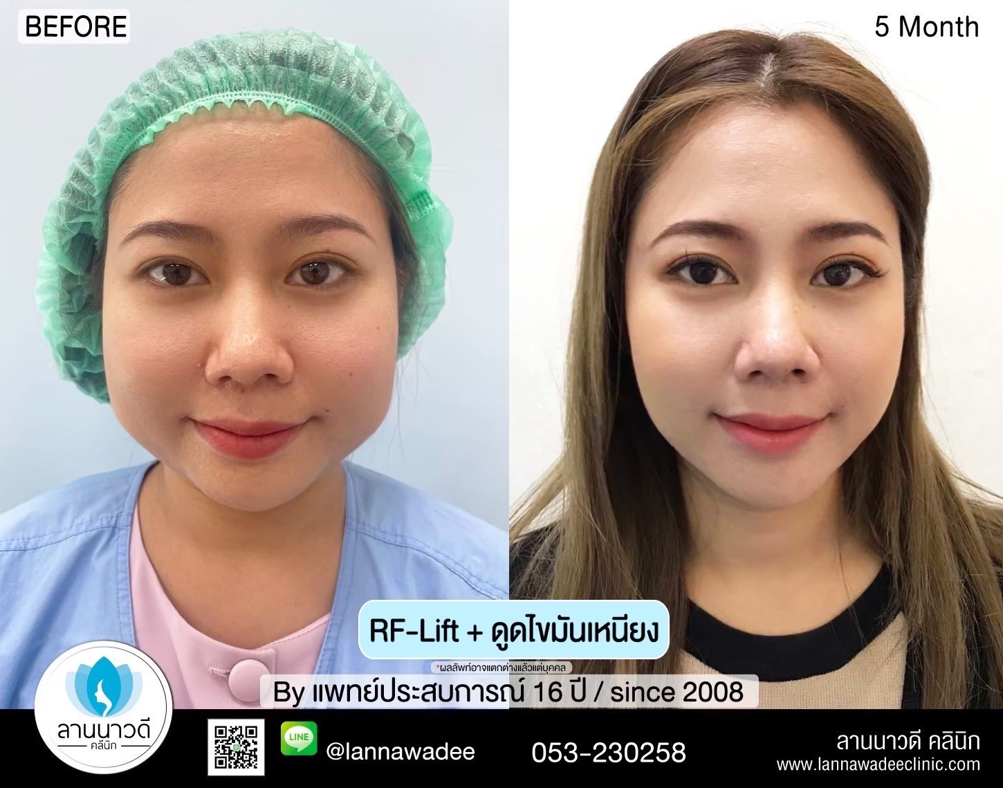 นวด RF