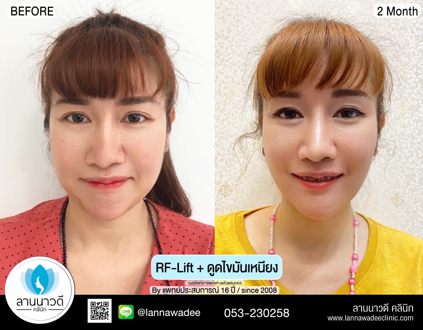 นวด RF