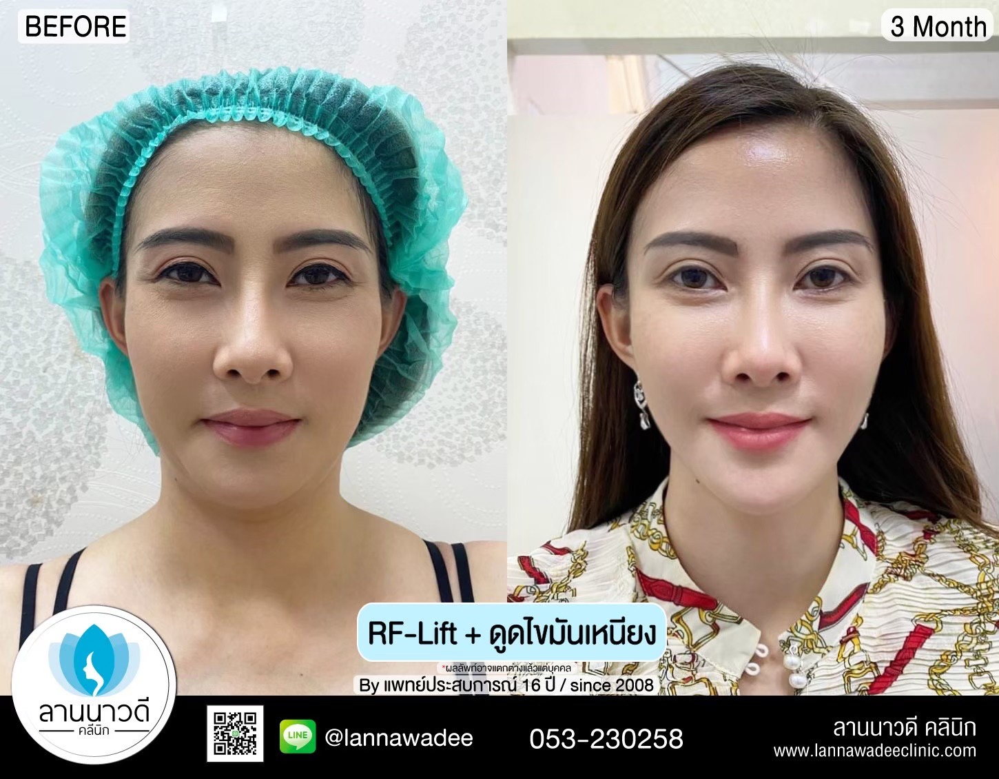 นวด RF