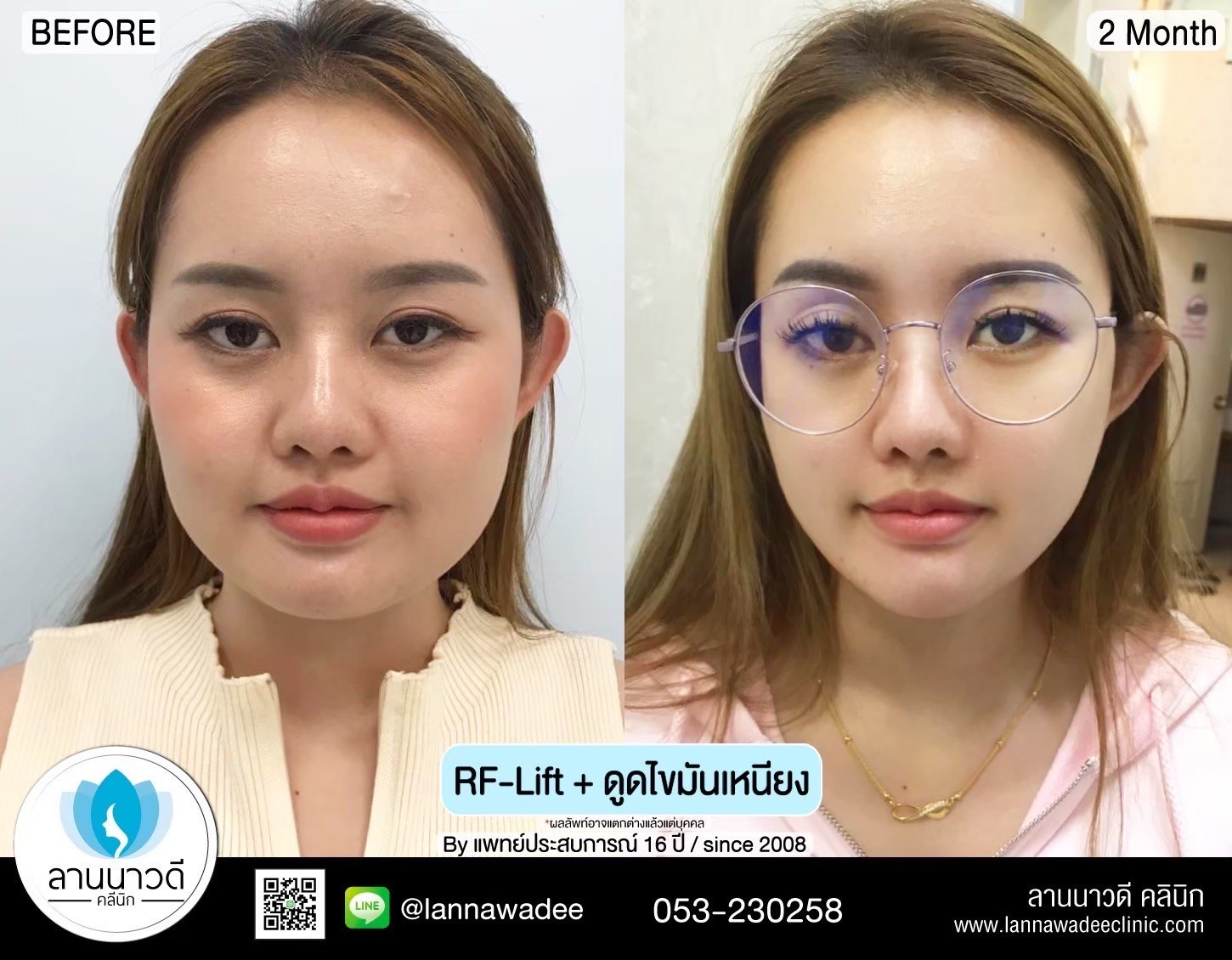 นวด RF