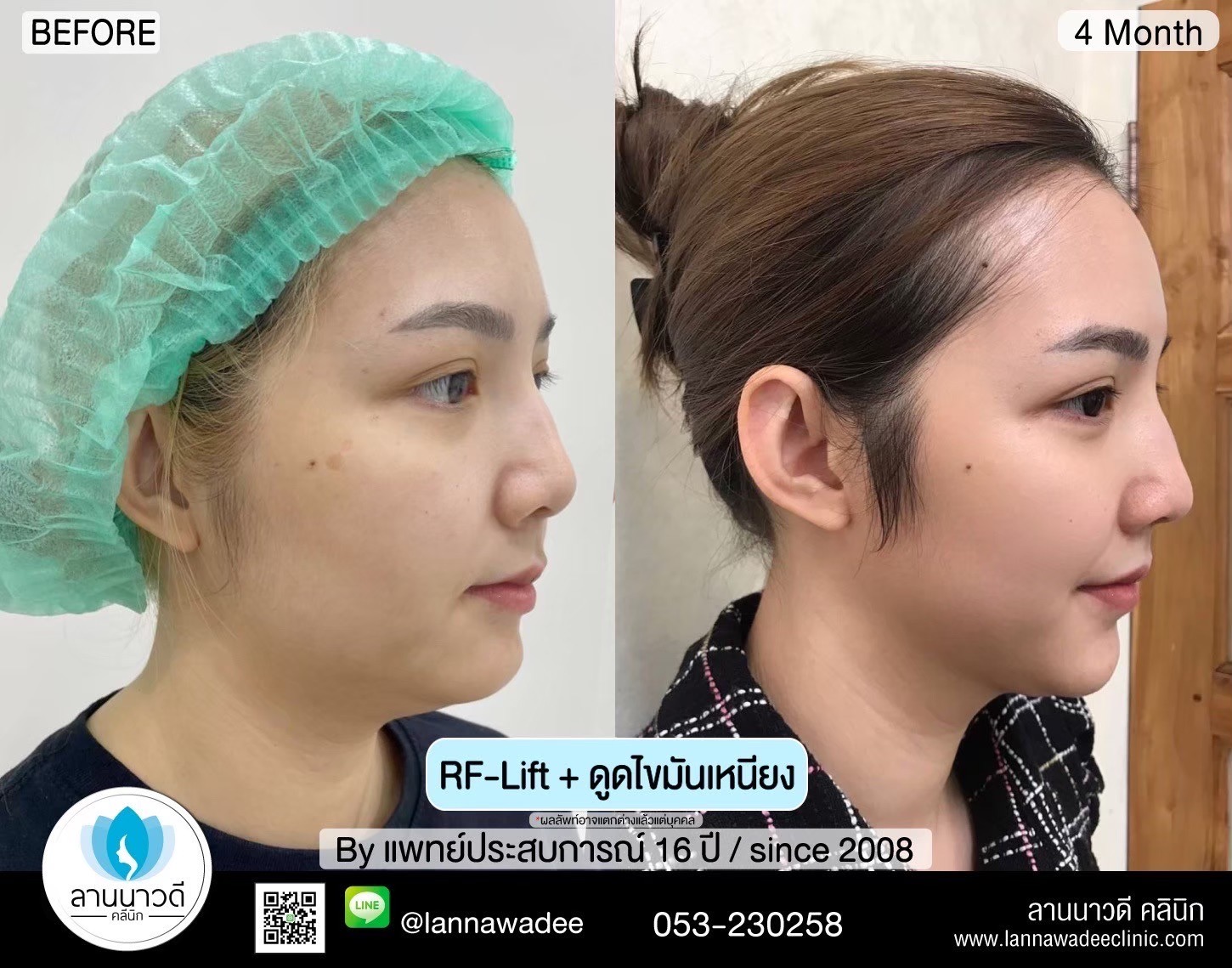 นวด RF