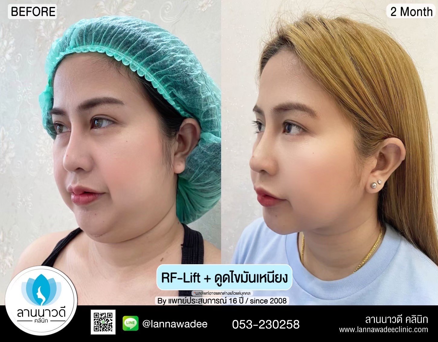 นวด RF