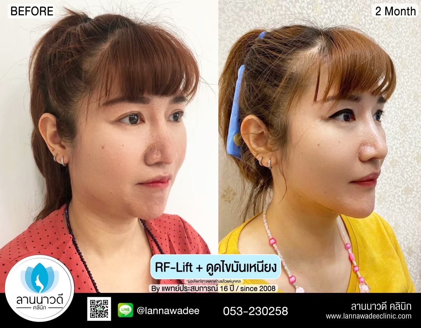 นวด RF