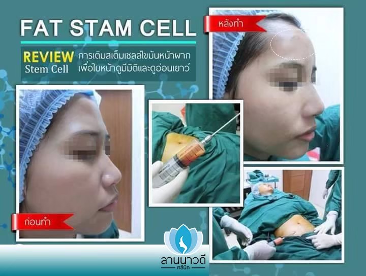 ฉีดไขมันหน้า
