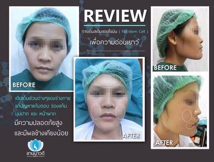 ฉีดไขมันหน้าเด็ก