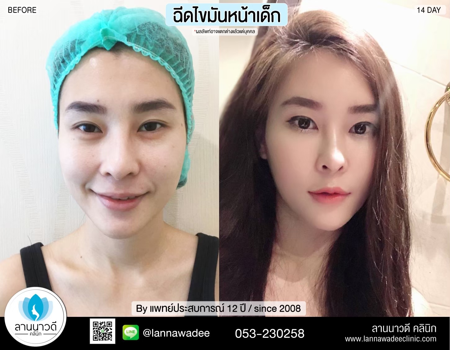 เติมไขมันหน้า