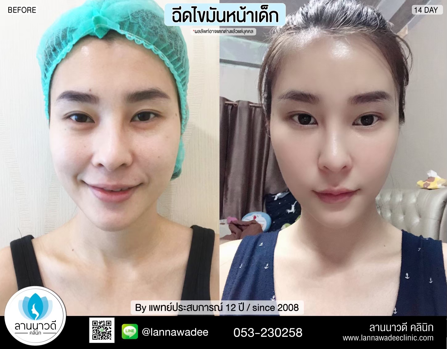 เติมไขมันหน้า