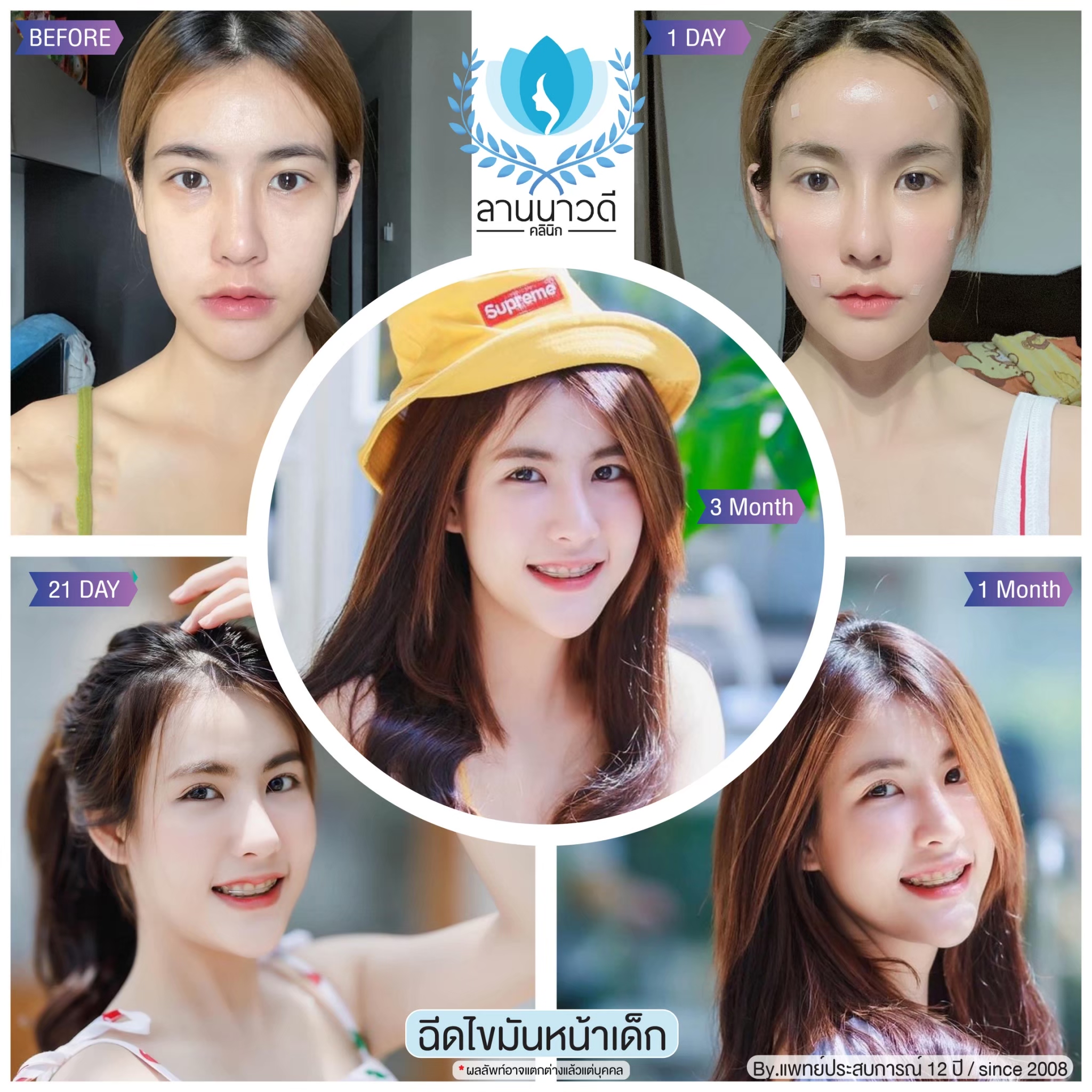 ฉีดไขมันหน้าเด็ก