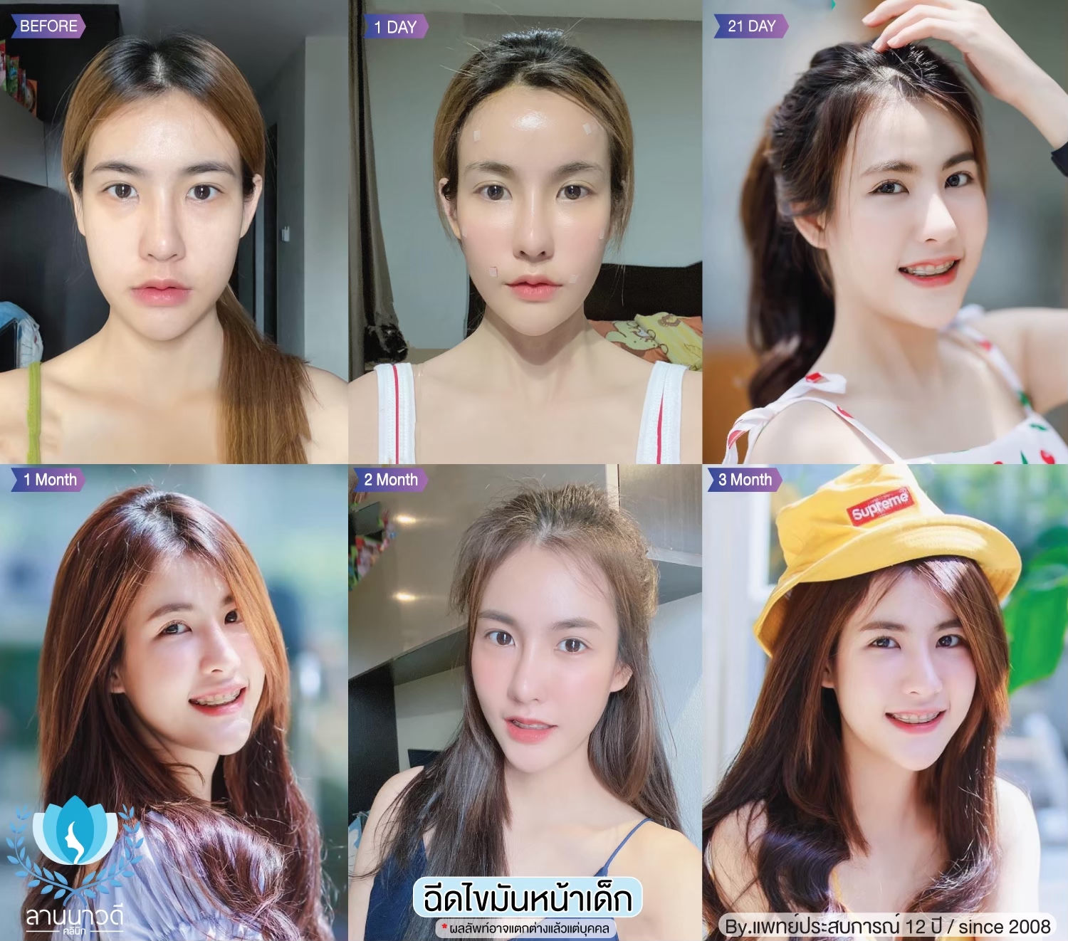 เติมไขมันหน้า