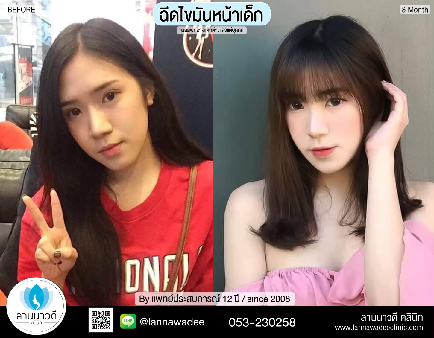ฉีดไขมันหน้า