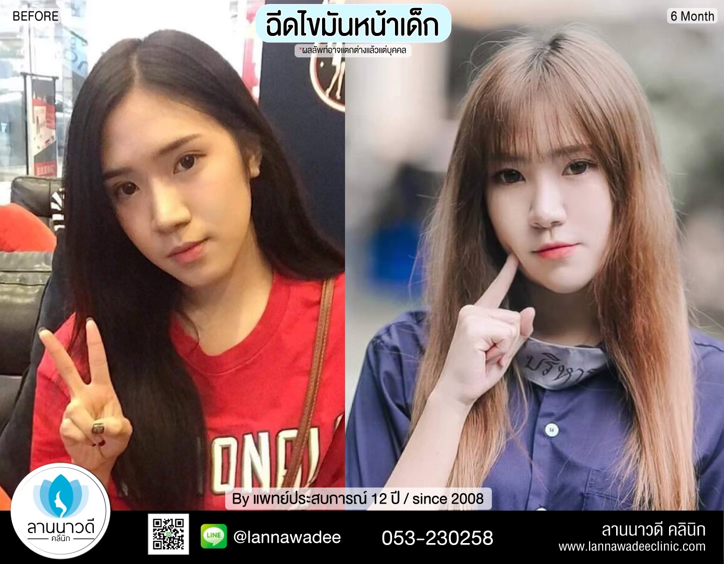 ฉีดไขมันหน้า