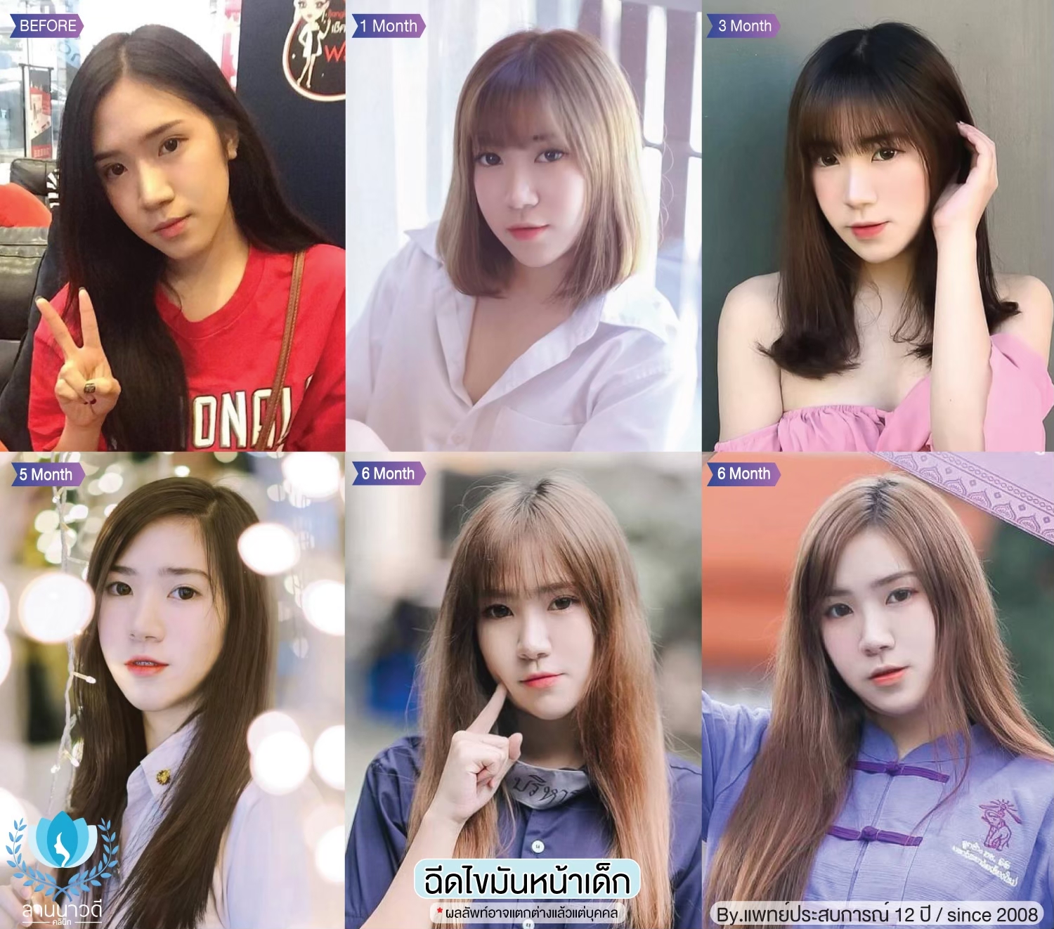 เติมไขมันหน้า