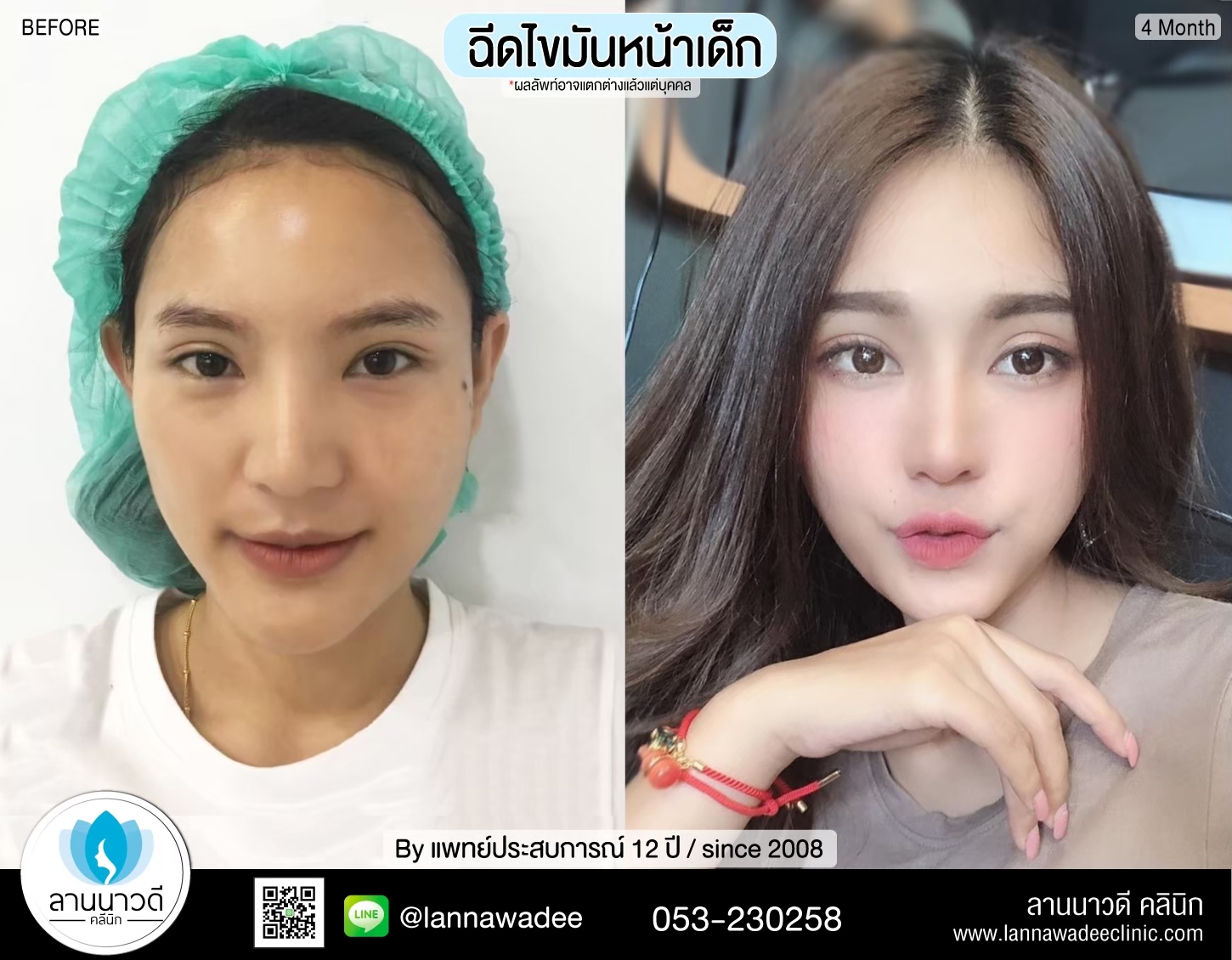 ฉีดไขมันหน้า