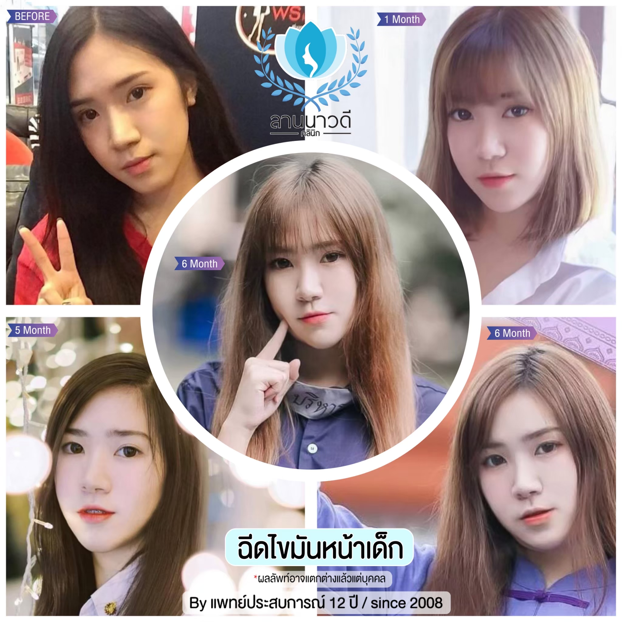เติมไขมันหน้า