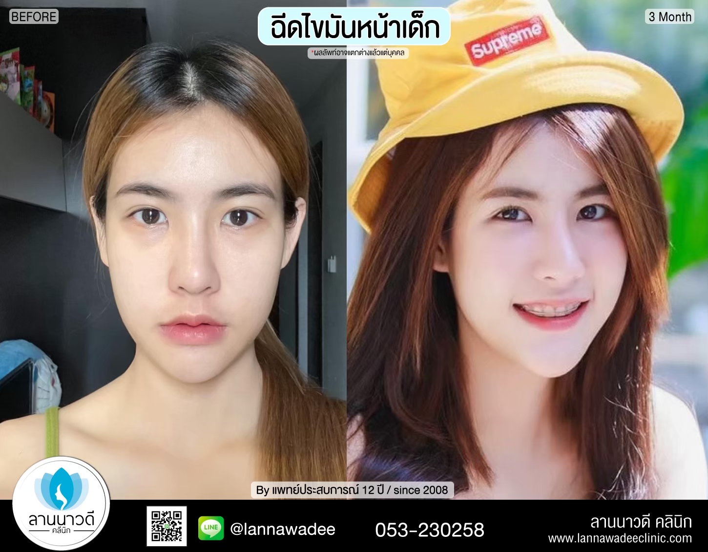เติมไขมันหน้า