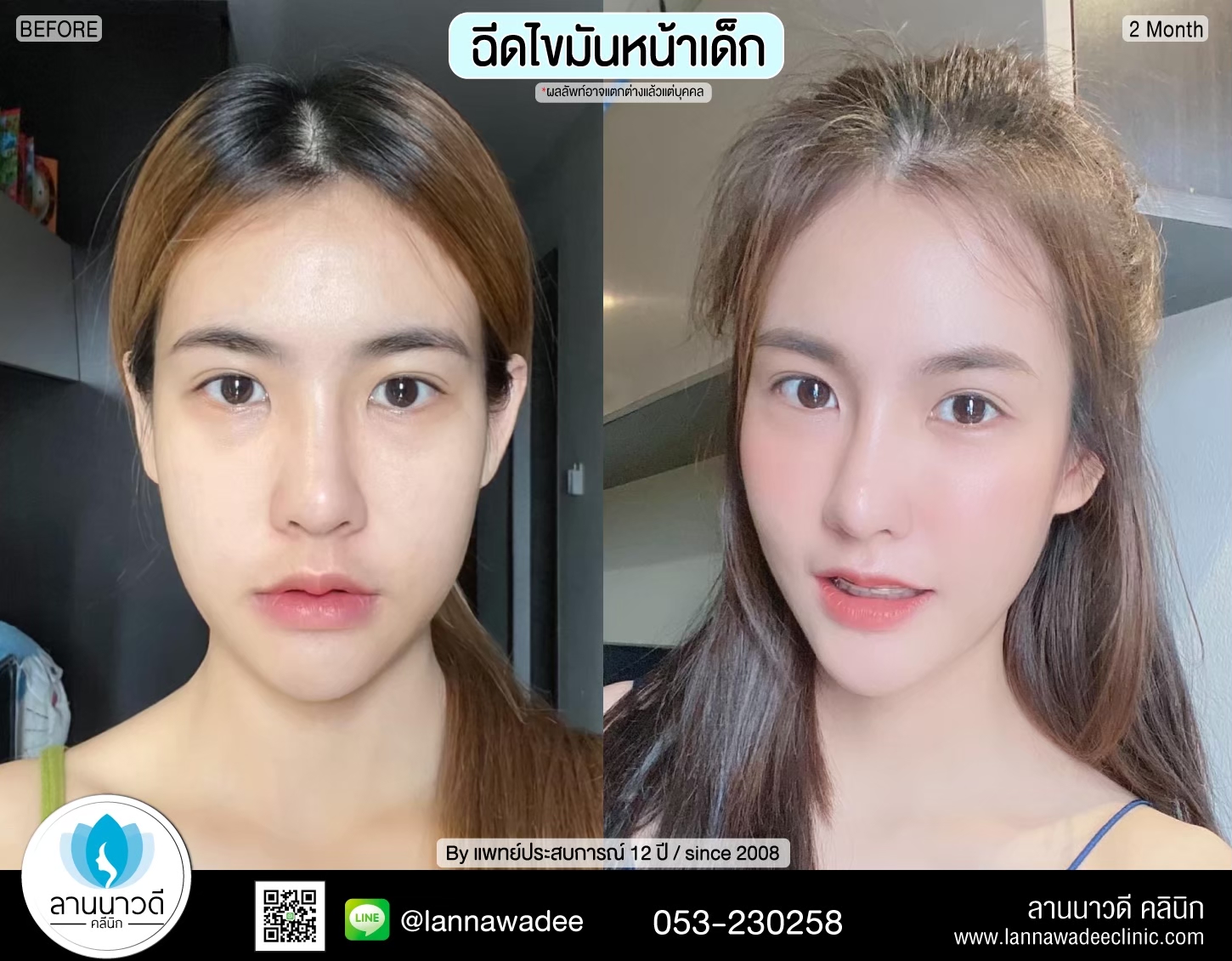 ฉีดไขมันหน้า