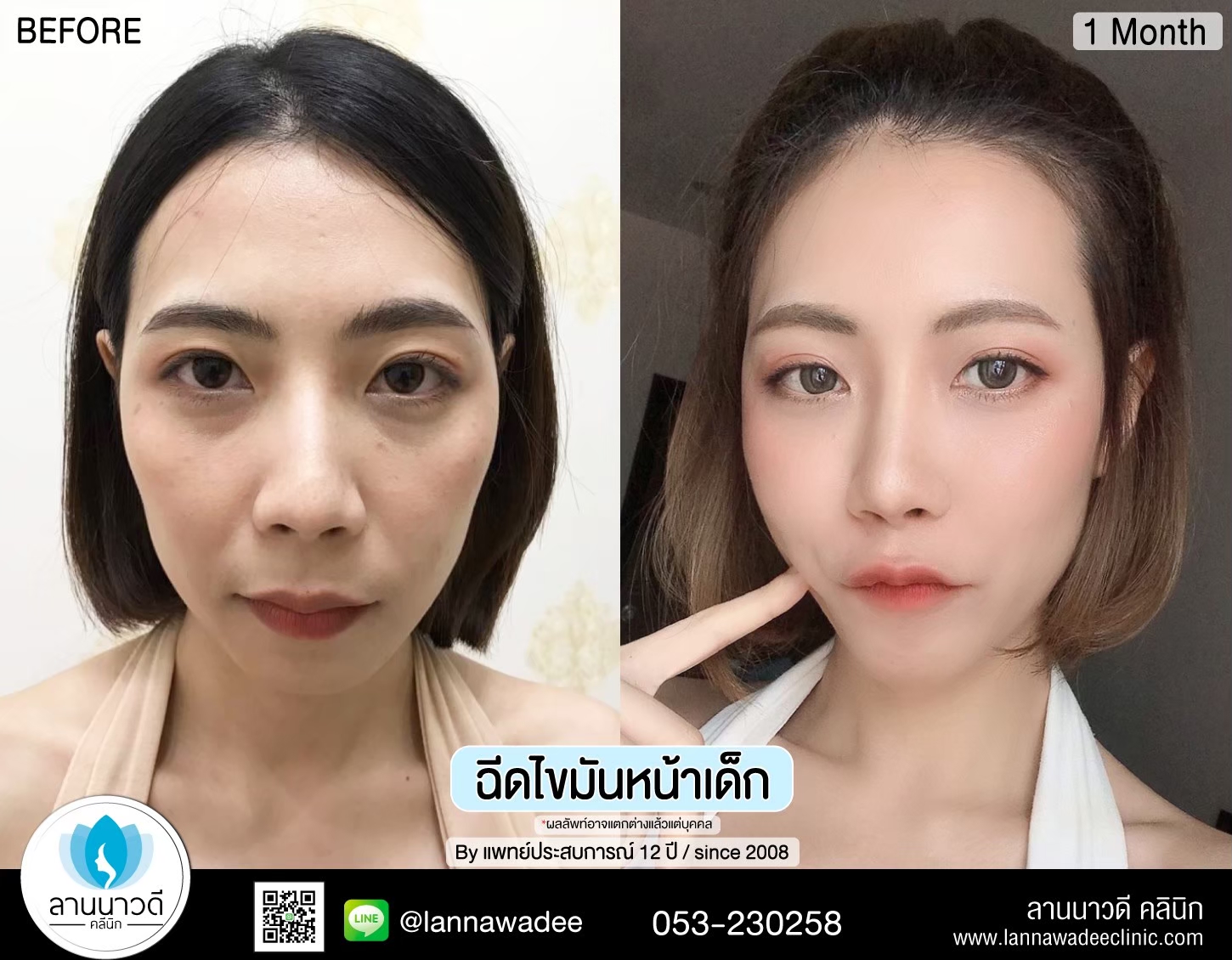 เติมไขมันหน้า