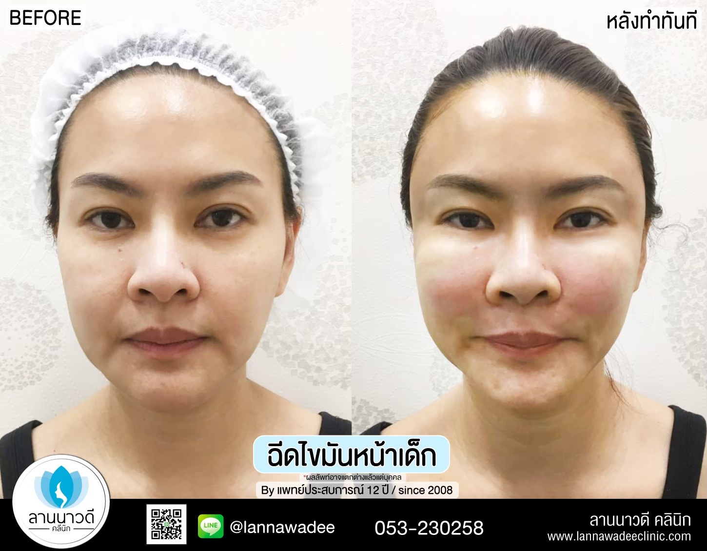 เติมไขมันหน้า