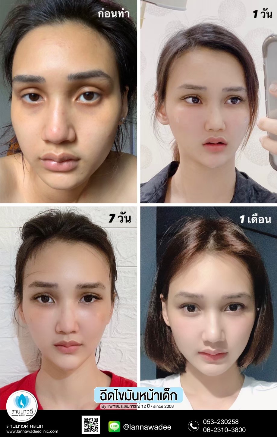 ฉีดไขมันหน้า