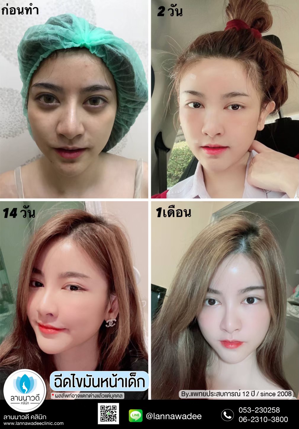 ฉีดไขมันหน้า