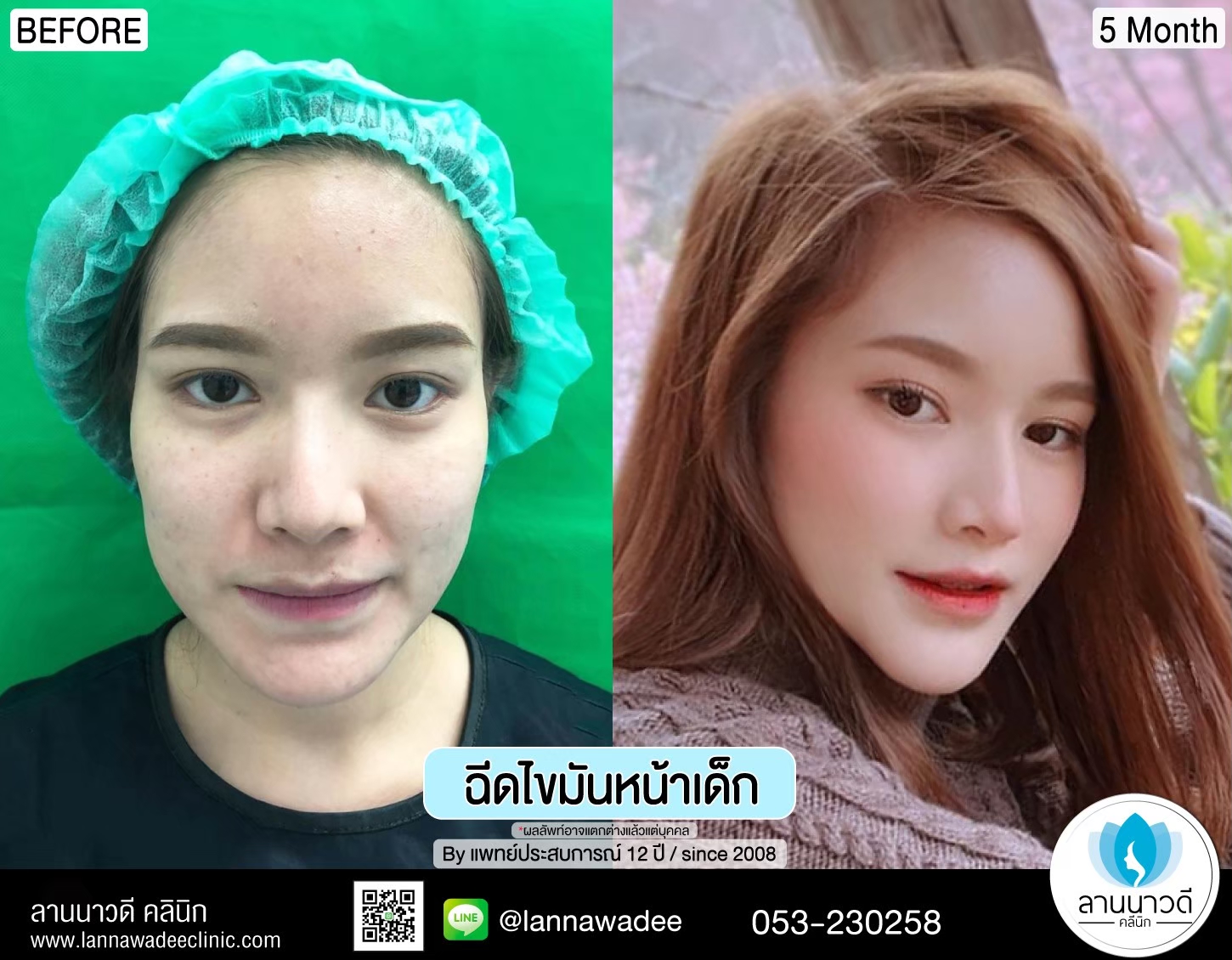 ฉีดไขมันหน้าเด็ก