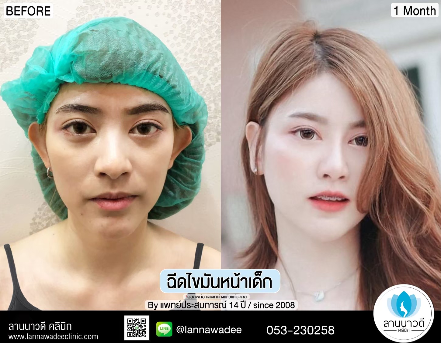 ฉีดไขมันหน้าเด็ก