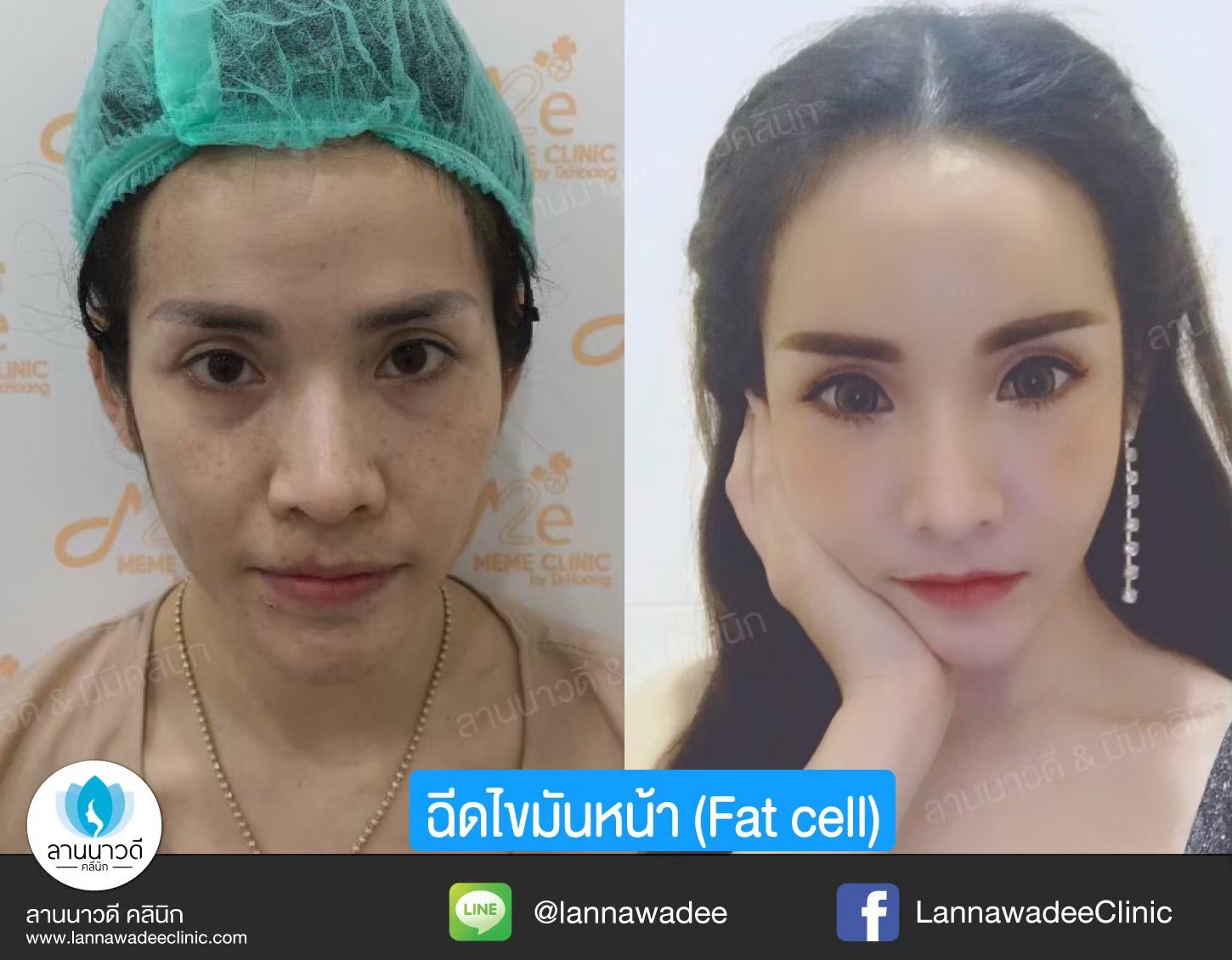 ฉีดไขมันหน้า