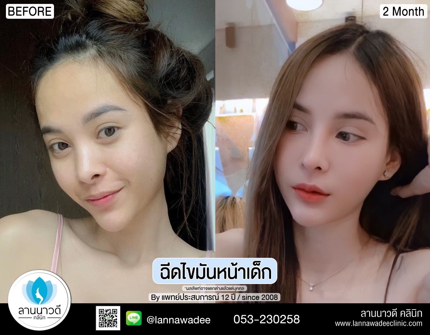 ฉีดไขมันหน้า