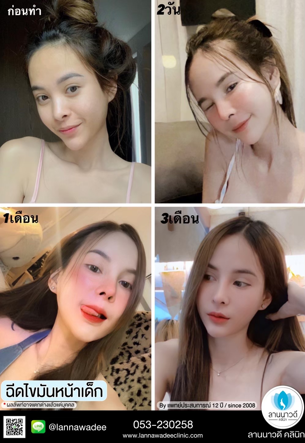 ฉีดไขมันหน้า