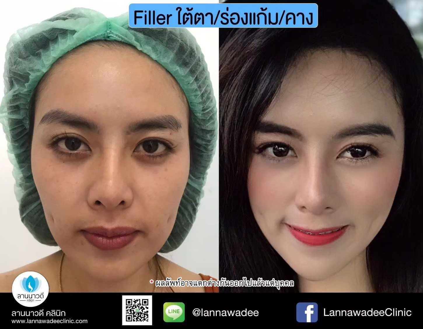 ฉีดไขมันหน้า