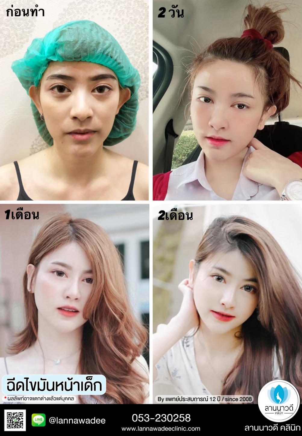 เติมไขมันหน้า