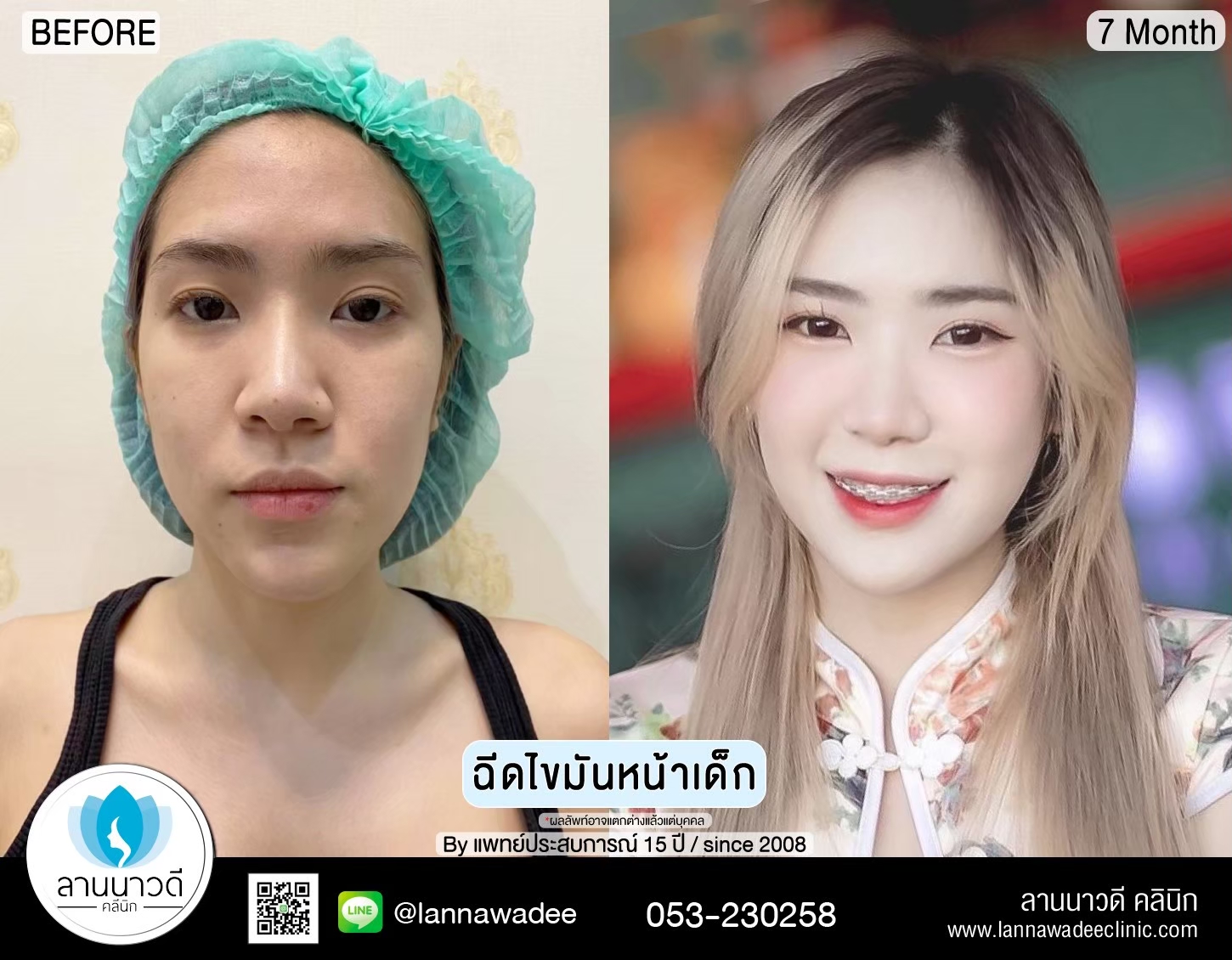 เติมไขมันหน้า