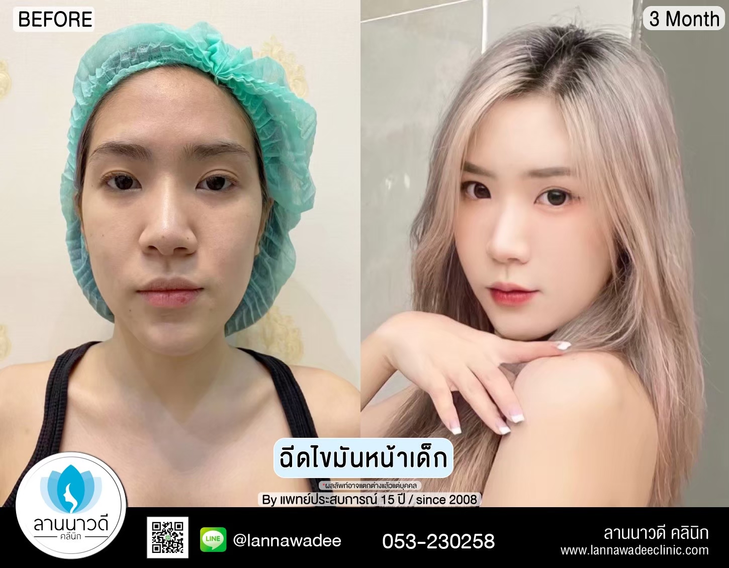 ฉีดไขมันหน้าเด็ก