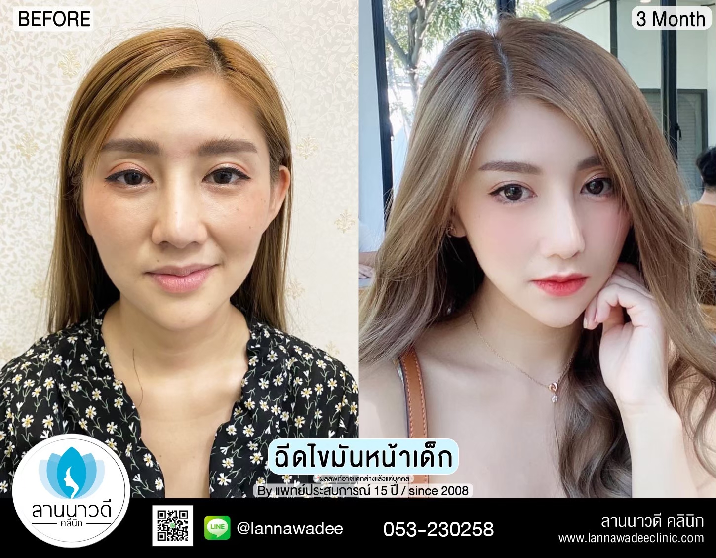 เติมไขมันหน้า