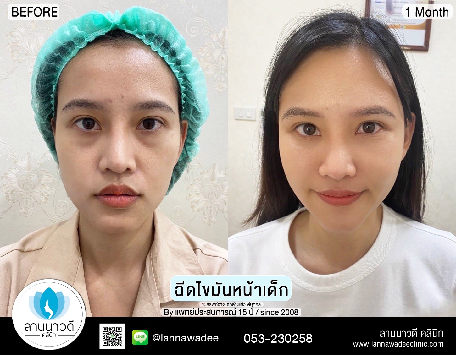 ฉีดไขมันหน้าเด็ก