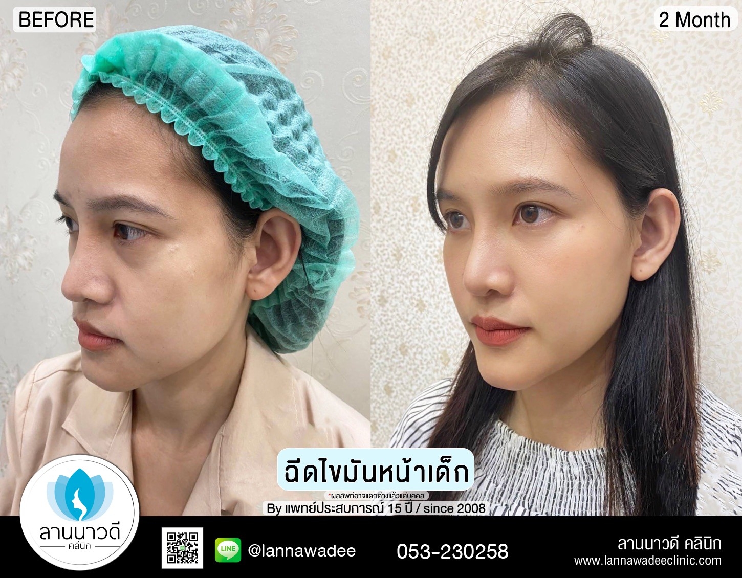 ฉีดไขมันหน้าเด็ก