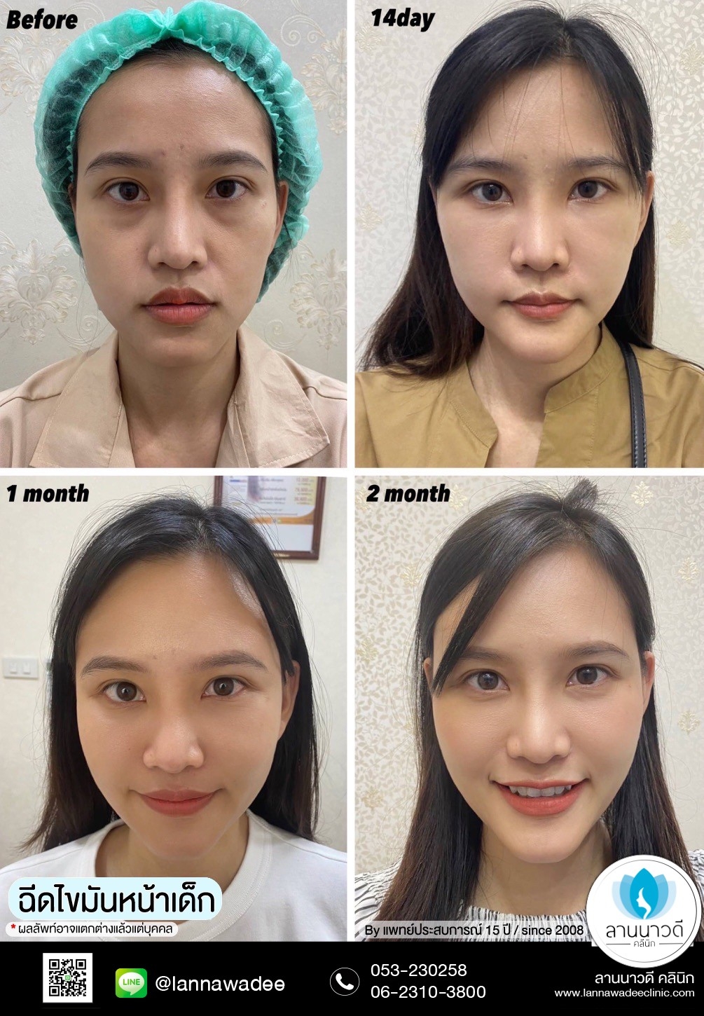 ฉีดไขมันหน้า