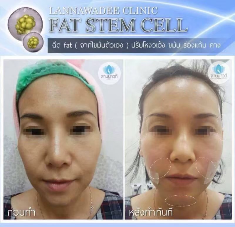 ฉีดไขมันหน้า