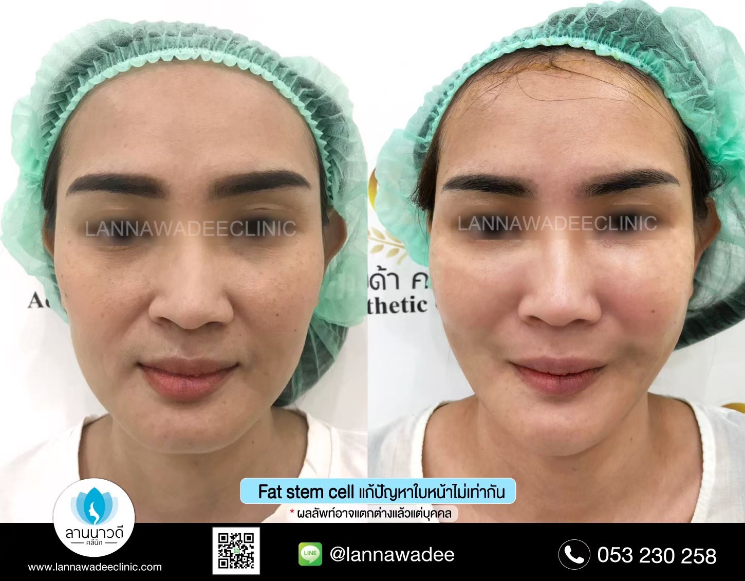 ฉีดไขมันหน้าเด็ก